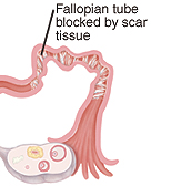 Fallopain tube blocked by scar tissue