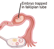 Embryo trapped in fallopian tube
