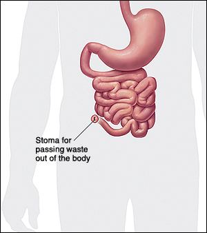 Stoma is formed to pass waste.