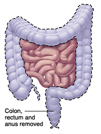 Image of the intestines with colon, rectum and anus highlighted to show what portion is removed.