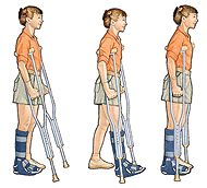 Image of girl on crutches