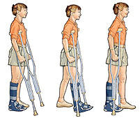 Discharge Instructions: Using Crutches (Weight-Bearing)