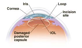 Cross section of front part of eye showing anterior capsule IOL.