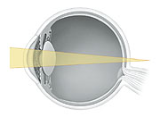 Cross section of eye showing light focusing behind retina.
