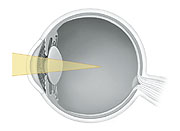 Cross section of eye showing light focusing in front of retina.