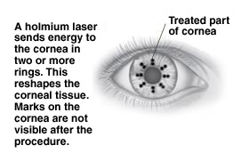 Drawing of eye showing the treated part of the cornea