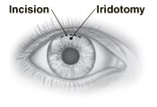 Front view of eye showing incision at top of iris, and hole for iridotomy.