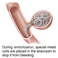 Special metal coils are used to stop an aneurysm from bleeding.