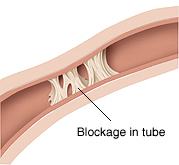 Closeup of fallopian tube with blockage.