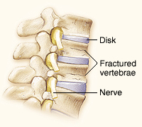 Side view of vertebrae, disks, and nerves showing compression fractures in vertebrae.