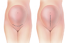 Types of incisions