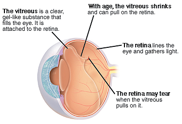 Three-quarter view of cross-sectioned eye showing shrinking vitreous pulling on retina.