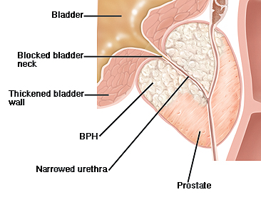 Cross section of prostate and base of bladder. BPH is narrowing urethra in prostate, and thickened bladder wall is blocking bladder neck.