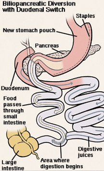 Front view of stomach and duodenum. Stomach has been cut and stapled. Cut end of small intestine has been brought up to connect to stomach. Duodenum has been cut and reattached to small intestine. Arrow shows food passing from stomach into shortened small intestine. Another arrow shows path of digestive juices from stomach through duodenum and into small intestine. Digestion begins in small intestine.