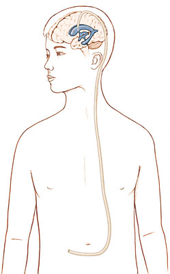 Outline of boy showing ventricles in brain with tube running from ventricle down back of head and neck, through chest, and into abdomen.