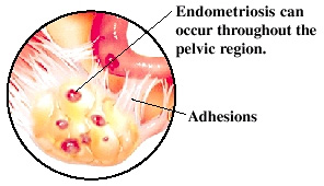 Illustration showing endometriosis of the reproductive organs