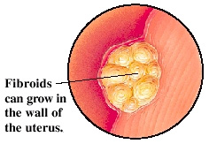 Illustration showing fibroids of the reproductive organs