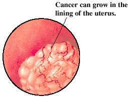 Illustration showing cancer growing in the lining of the uterus