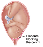 Placenta blocking the cervix.