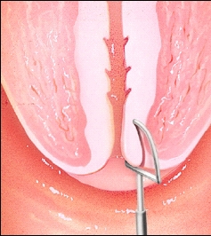 Closeup of cross section of cervix showing loop-shaped instrument removing tissue from cervix.