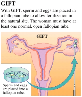 Cross section of uterus showing GIFT. Laparoscopic instrument is releasing sperm and eggs into open end of fallopian tube. Label reads: With GIFT, sperm and eggs are placed in a fallopian tube to allow fertilization in the natural site. The woman must have at least one normal, open fallopian tube. Inset of sperm and eggs in lab dish with label: Sperm and eggs are placed into a fallopian tube. 