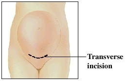 Image of transverse incision