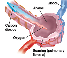 Closeup of bronchiole and alveoli showing pulmonary fibrosis.