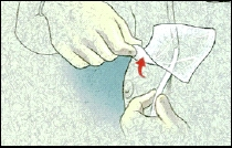Image of IV catheter