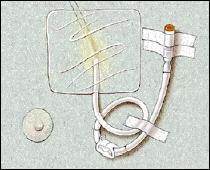Image of IV catheter