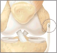 Cutaway view of knee showing the medial collateral ligament
