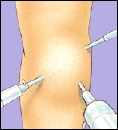 Image of arthroscope inserted into the knee joint