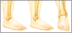 Image of ankle bones showing sites of common fractures