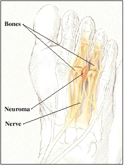 Sole of foot showing bones, nerves, and a neuroma between two bones.