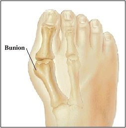Top of foot showing bones of big toe and moderate bunion.