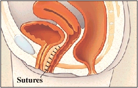 Cutaway view of pelvis