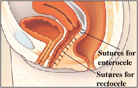 Cutaway view of rectum and vagina