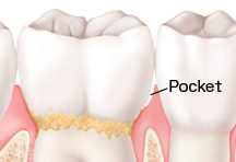 Teeth in gums showing gingivitis.