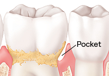 Teeth in gums showing periodontitis.
