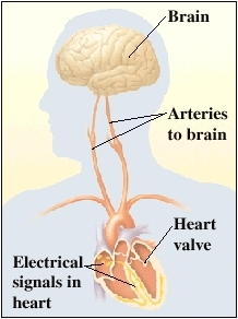 Outline of upper body with head turned to side. Cross section of heart in chest showing heart's electrical system in right atrium and heart walls. Arteries from heart go through neck to brain.
