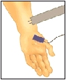 Image of hand/arm with electrode attached.