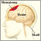 Bleeding between the brain and skull (hematoma). 