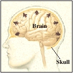 Brain swelling against the skull.