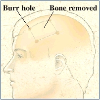 Side view of head with skull inside. Four small holes are in skull at corners of rectangle. Bone inside rectangle is removed.