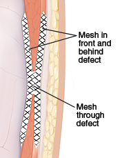 Cross section of abdominal wall showing mesh repair in front of, through, and behind hernia defect.