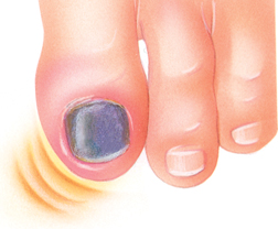 Closeup of big toe with black-and-blue nail.