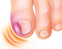 Closeup of big toe with ingrown nail causing swelling.