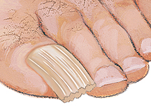 Closeup of big toe with thick nail.