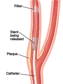 Cross section of internal and external carotid arteries. Catheter is inserted in internal carotid past plaque in artery wall. Catheter is releasing stent into artery. Filter is at end of catheter.