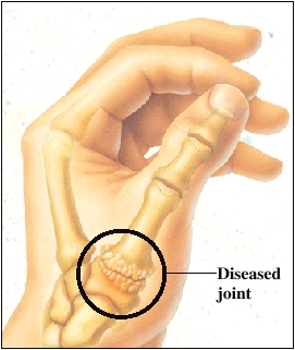 Image of a thumb with a diseased basal joint.