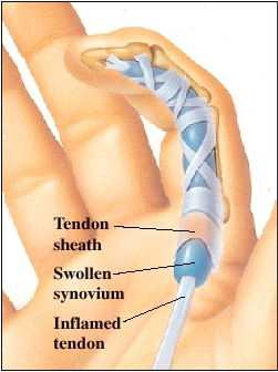 Image showing a finger with an inflamed tendon and swollen synovium